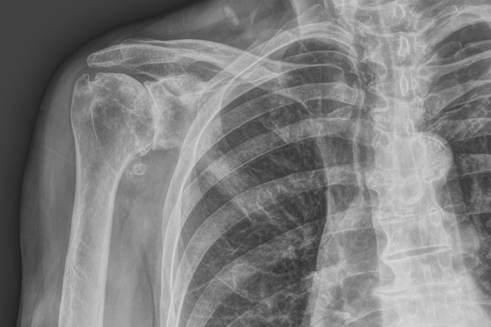 Exploring Effective Advanced Shoulder Arthritis Treatments Exploring Effective Advanced Shoulder Arthritis Treatments