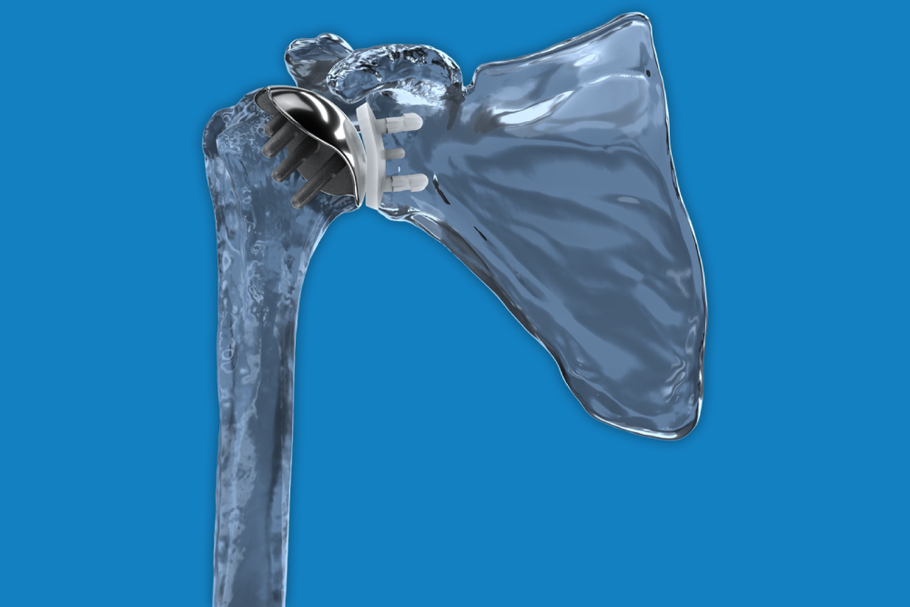 The Catalyst OrthoScience Story: How Dr. Goldberg Innovates in Shoulder Surgery The Catalyst OrthoScience Story: How Dr. Goldberg Innovates in Shoulder Surgery